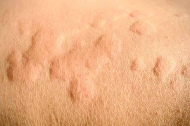 People with shellfish allergy may also be allergic to shrimp.