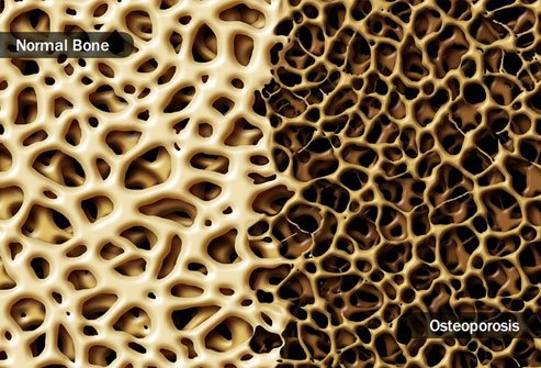 Paleo diets may fall short on calcium and vitamin D, which you need for healthy bones.