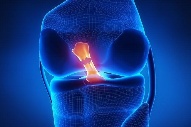 This usually happens in the anterior cruciate ligament, or ACL, which runs crosswise in the middle of your knee.