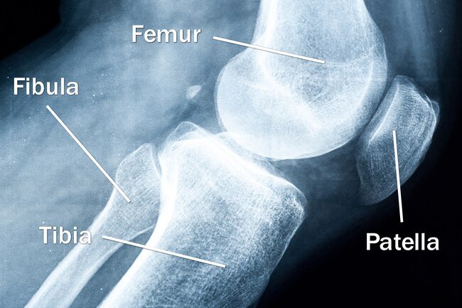 Four bones meet to form your knee: your thighbone (femur), shinbone (tibia), the smaller bone that runs alongside it (fibula), and kneecap (patella).