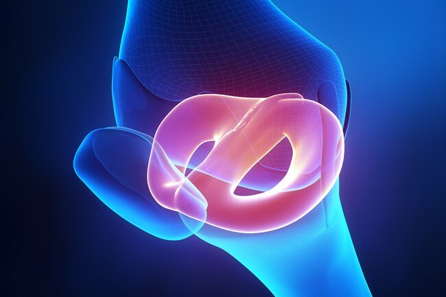 When the doctor says you've torn cartilage in your knee, it's most likely these two triangle-shaped pieces.