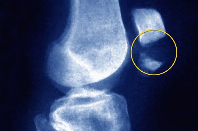 You can crack or break any of the bones in your knee, but the kneecap, or patella, is the most common.