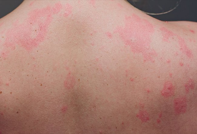 symptoms of mast cell activation syndrome