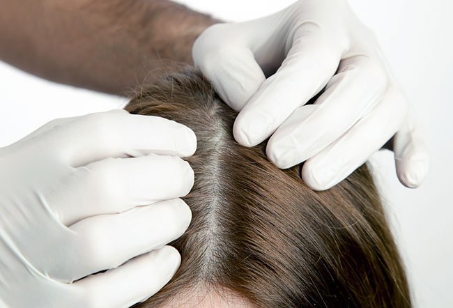 Alopecia areata is a condition that occurs when your child's immune system attacks the hair follicles, causing hair loss. Your child will have patchy hair loss that may occur anywhere on the body where hair grows.