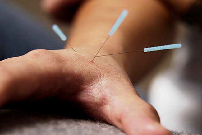 Acupuncture may lower levels of substances like tumor necrosis factor (TNF), which cause joint swelling.