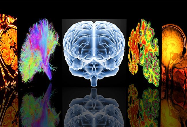 multiple sclerosis (MS) diagnosis