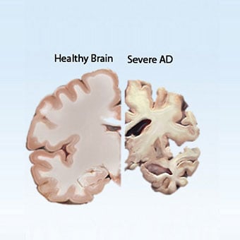 The cross section of a healthy brain in contrast with a diseased brain.
