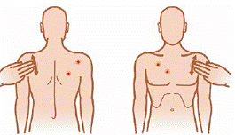 If acne is present on other parts of your
body (neck, shoulders, arms, back or chest) - Illustration