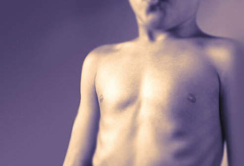 Retractions are a sign of a medical emergency of a severe asthma attack.