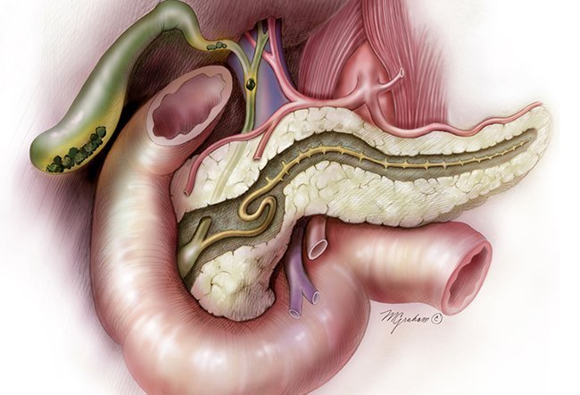 Is a neuroendocrine tumor the same as pancreatic cancer	