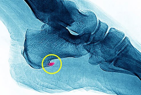 An enthesopathy is a disorder that affects locations where ligaments and tendons attach to bones.