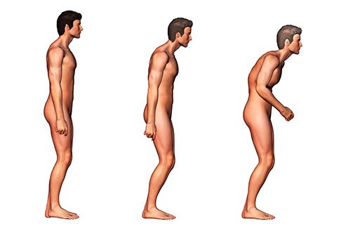 Almost everyone who has AS experiences periods of exacerbation of symptoms and remissions.