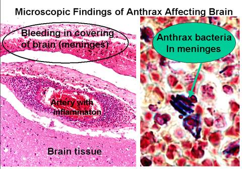 Brain Anthrax Photo - Anthrax Affecting Brain