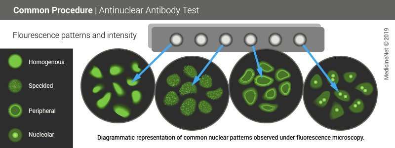 Diagram shows what pathologists see under the microscope in an ANA test