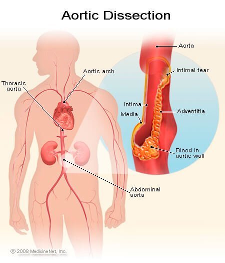 An aortic dissection is a small tear in the tunica intima (the inside layer of the aortic wall in contact with blood).