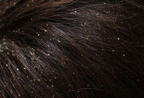 ACV is not a proven home remedy for dandruff.