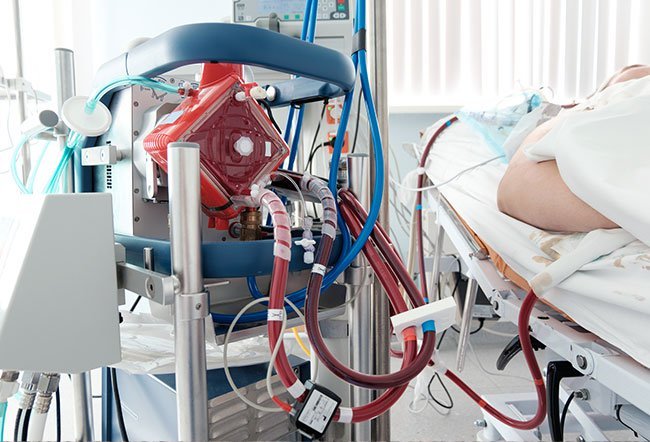 Extracorporeal membrane oxygenation (ECMO) is lifesaving support