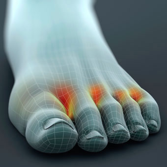 A 3-D model of a foot highlights the presence of fungal athlete's foot.