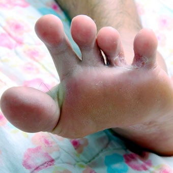 An example of an athlete's foot shows dry, flaky, and peeling skin on the soles and between the toes.