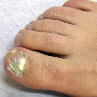A complication of an athlete's foot is fungal nail infection (onychomycosis).