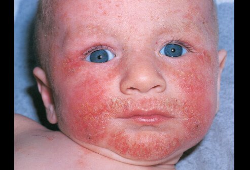 Picture of Atopic Dermatitis in Children