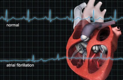 The Misconduction of the Hear'ts Electrical System in AFib