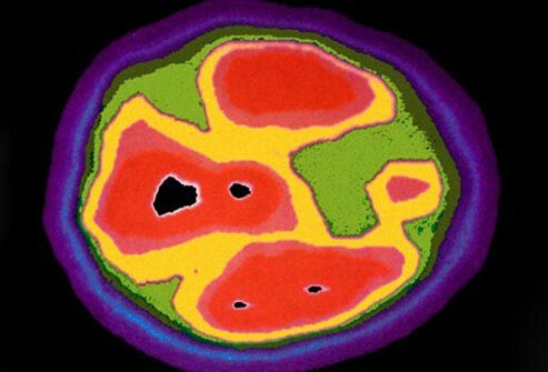 Children affected by autism have an excess of synapses, or connections between brain cells.