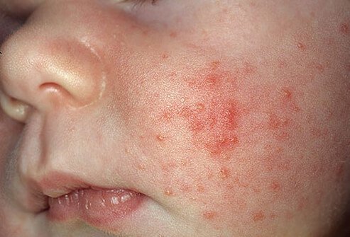 Acne neonatorum, also called neonatal or baby acne, is caused by maternal hormones.