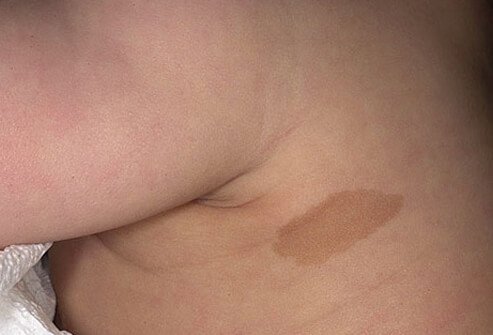 Birthmarks can be found in 5%-10% of all babies.