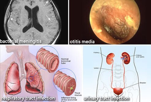  Other Bacterial Infections