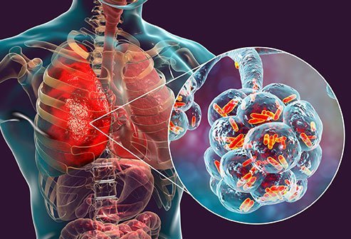 Viral pneumonia causes a dry cough, fever and other symptoms. 