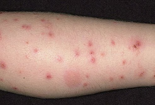 Some people may develop an allergic reaction to a flea bite.