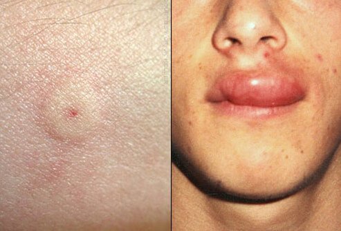 If you are allergic to bees, hornets, wasps, or yellow jackets, seek emergency care immediately to prevent or manage an anaphylactic reaction.