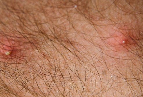 When a fire ant bites you, you will feel it! An itchy hive will develop.