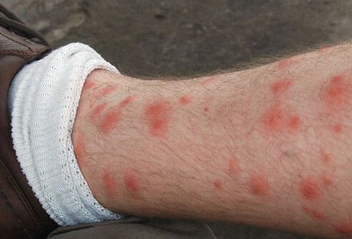 Itching from chigger bites is most intense 1 to 2 days following the bite