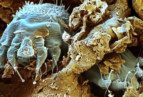 Scabies are mites that burrow into the skin, causing intense itching.