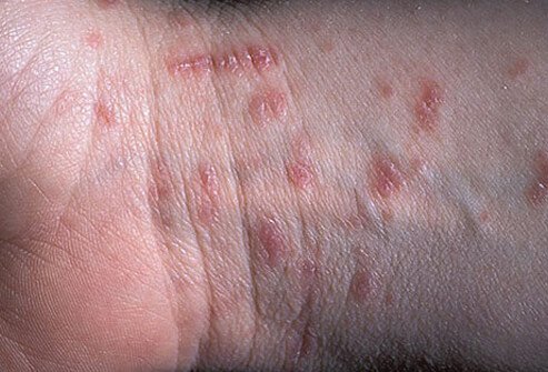 The intense itch is usually worse at night.
