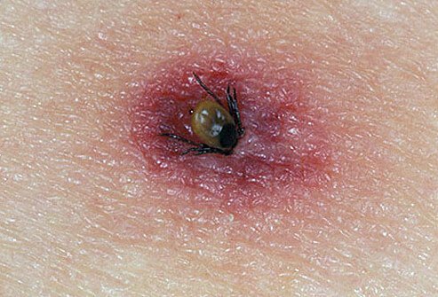 Most commonly, ticks attach to warm, moist, and hard-to-see parts of the body including the scalp, armpits, groin, skin folds, and other hairy areas.
