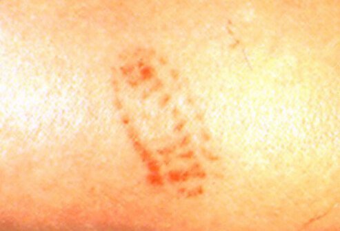 Symptoms of a puss caterpillar bite include immediate waves of intense pain, itchy rash, nausea and vomiting, restlessness, fever, muscle cramps, and symptoms of shock.
