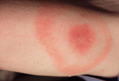 A circular, red, expanding rash (a 'bulls-eye' rash) is one of the first symptoms of Lyme disease.