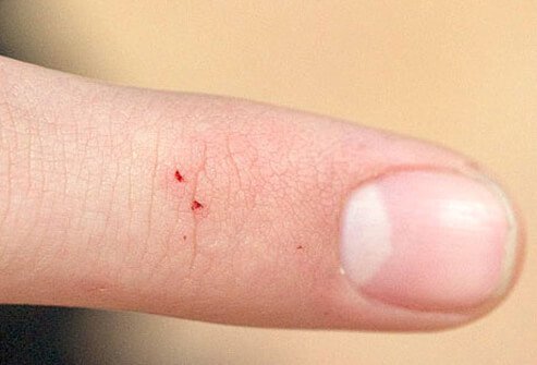 Black widow spider bite symptoms usually start 20 minutes to one hour following the bite.