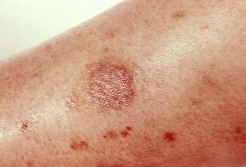 Brown recluse bites are usually painless.