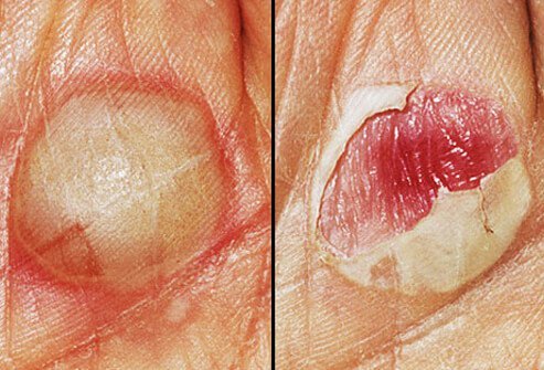 Keep blisters bandaged if they are on areas where they might get rubbed, like the bottom of the feet.