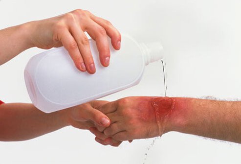 Treat minor burns by running them under cool water, using antibiotic ointment, and applying a non stick bandage. 