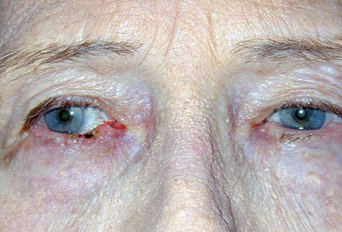 To differentiate a benign mole from a cancerous mole, you should look out for the following signs.