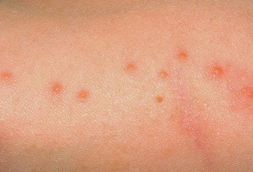 Bedbug bites typically are stealthy and not felt by the host.