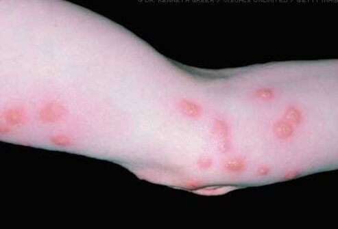 Secondary bacterial infection of the skin may develop in areas that become irritated due to prolonged scratching.