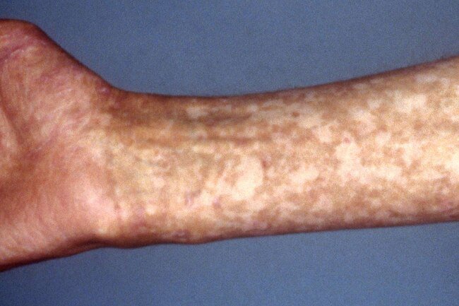 Light therapy may help with transplanted cells during a stem cell or bone marrow transplant.