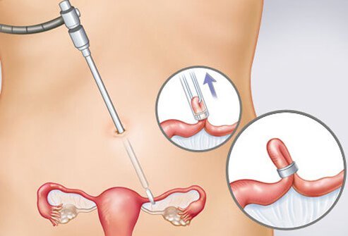 Tubal ligation is a surgical procedure that blocks, ties, or cuts the fallopian tubes so eggs do not travel into an area where contact with sperm is possible.