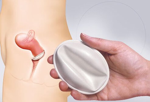Inserting the diaphragm is not as simple as using condoms, but practice makes perfect.